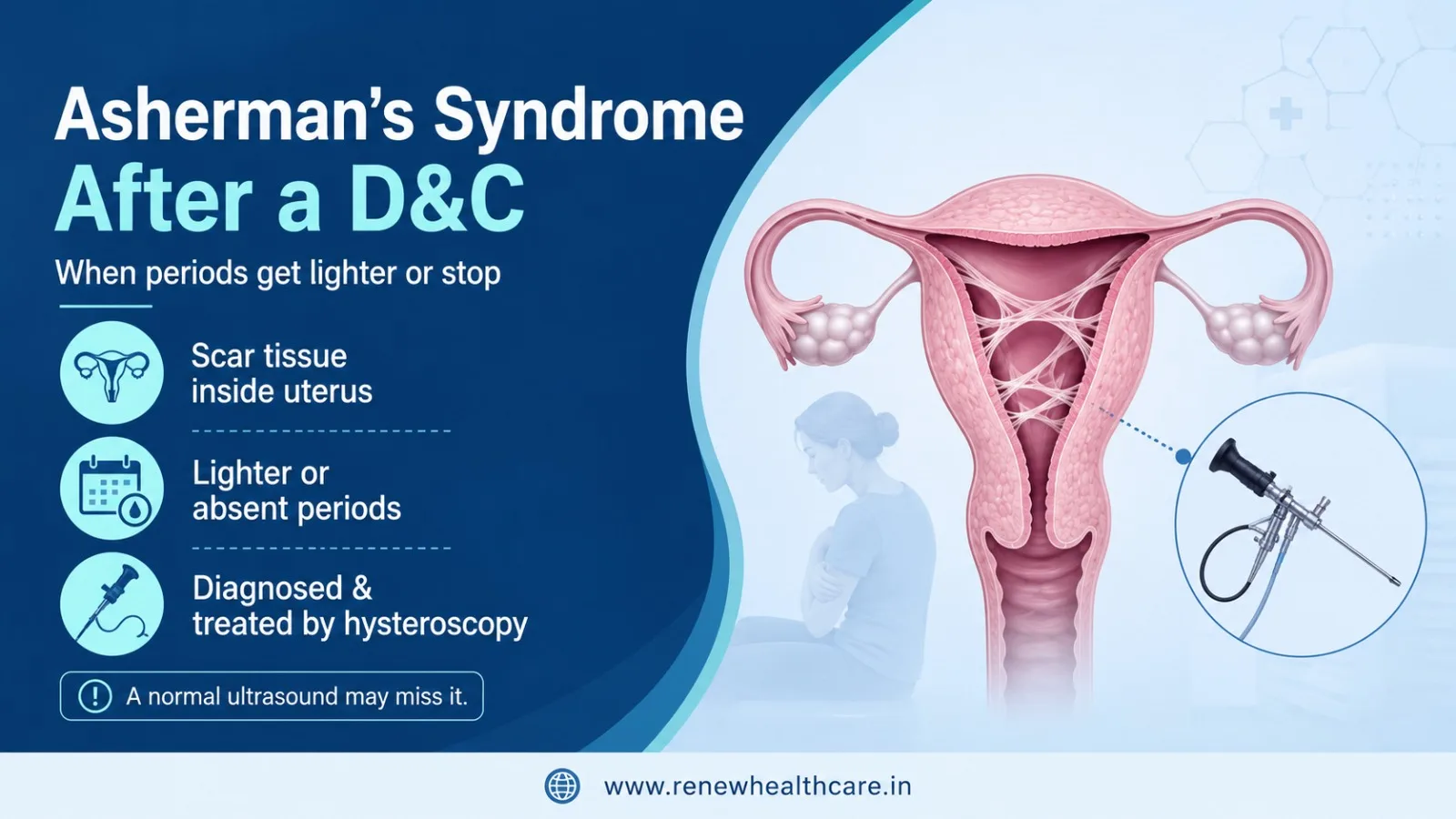 Asherman's Syndrome After a D&C: Why Your Periods Got Lighter, and What Can Be Done